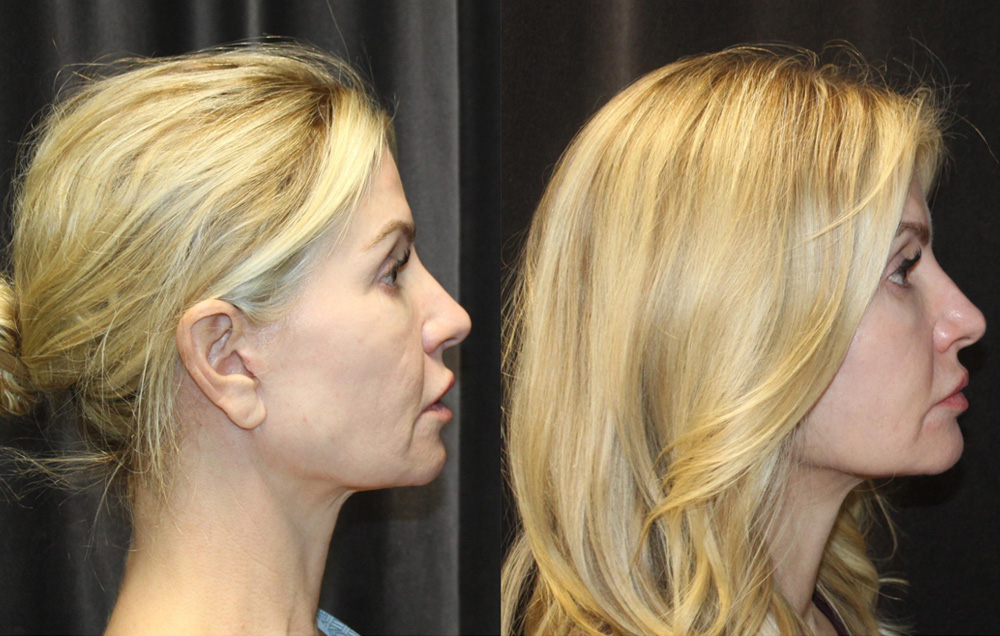 1.Facelift, 2. NeckLace platysmaplasty, 3. Co2 Laser to face, 4.Co2 Laser to neck and chest