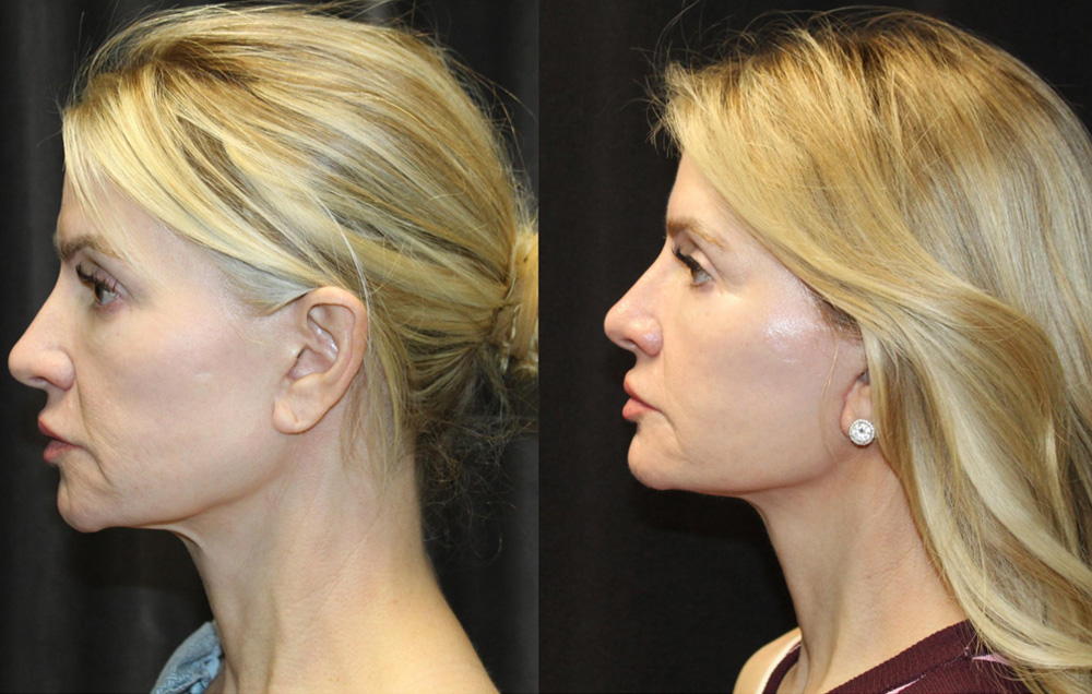 1.Facelift, 2. NeckLace platysmaplasty, 3. Co2 Laser to face, 4.Co2 Laser to neck and chest