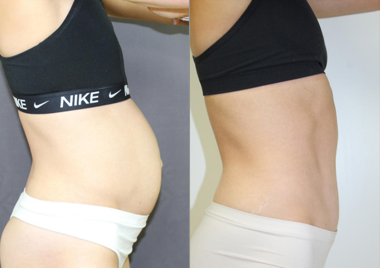 Hybrid tummy tuck with vertical incision and hernia repair