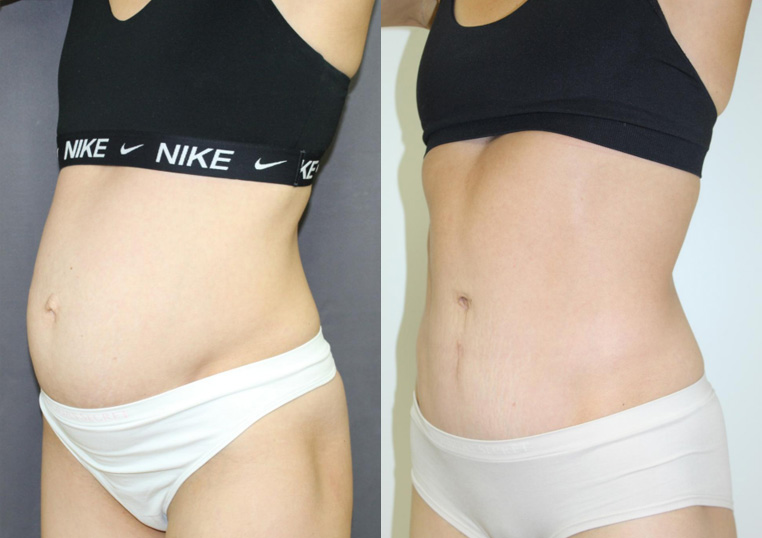 Hybrid tummy tuck with vertical incision and hernia repair