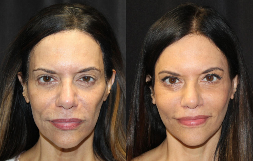Cervicofacial rhytidectomy, High SMAS technique, 2. Superficial cheeklift, - (USIC), 3. Harvest of fat fascial grafts from lower abdomen, 4. LiveFill to malar eminences, 5. LiveFill to submalar region, 6. LiveFill to temporal hollowing, 7. Lateral brow lift, nerve sparing, 8. Reverse brow lift with galeal scoring bilateral , CO2 laser resurfacing of face