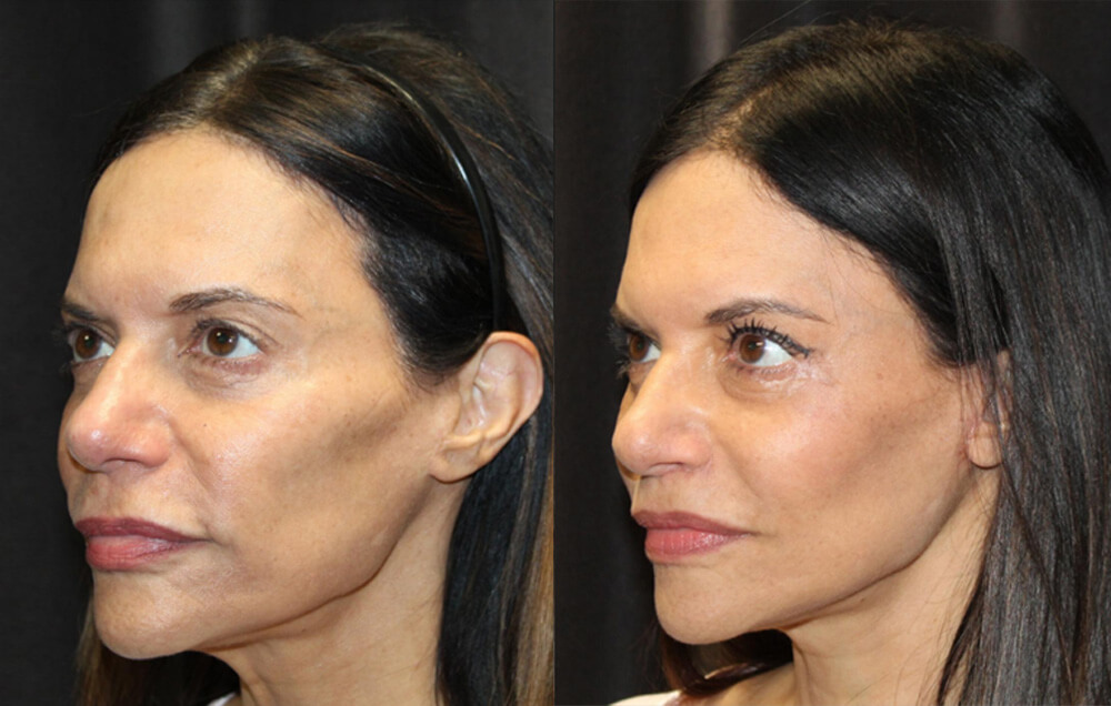 Cervicofacial rhytidectomy, High SMAS technique, 2. Superficial cheeklift, - (USIC), 3. Harvest of fat fascial grafts from lower abdomen, 4. LiveFill to malar eminences, 5. LiveFill to submalar region, 6. LiveFill to temporal hollowing, 7. Lateral brow lift, nerve sparing, 8. Reverse brow lift with galeal scoring bilateral , CO2 laser resurfacing of face