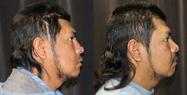 Facial scarring and nerve damage after an accident, treated with scar repairs, laser, nerve repairs.