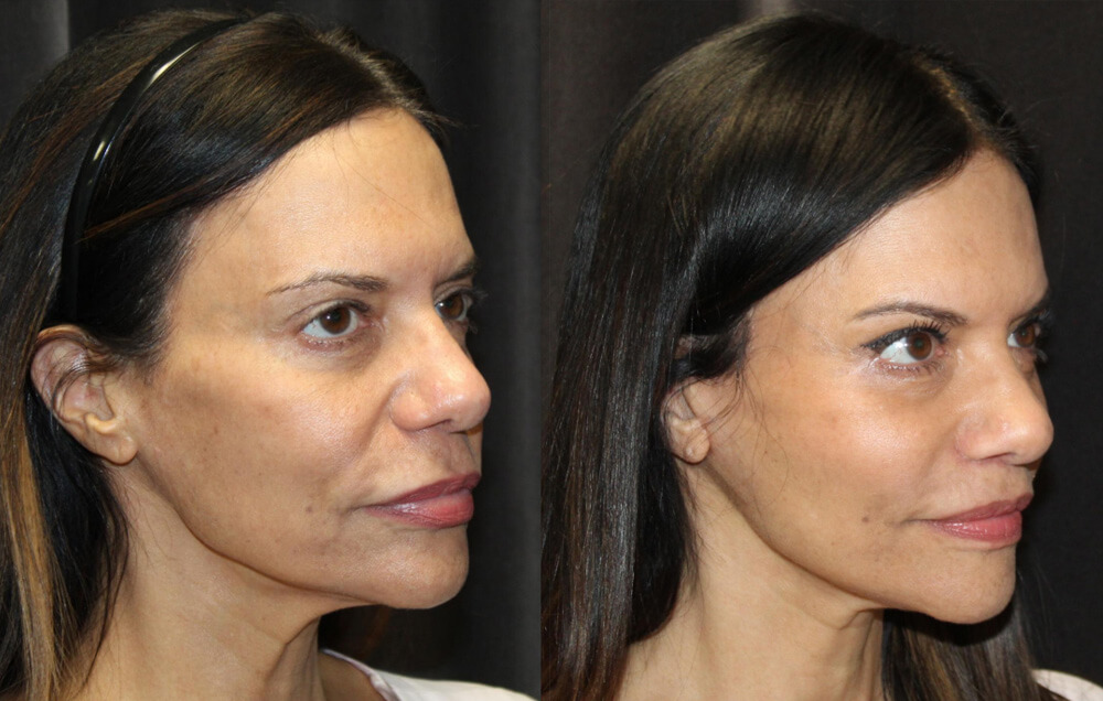 Cervicofacial rhytidectomy, High SMAS technique, 2. Superficial cheeklift, - (USIC), 3. Harvest of fat fascial grafts from lower abdomen, 4. LiveFill to malar eminences, 5. LiveFill to submalar region, 6. LiveFill to temporal hollowing, 7. Lateral brow lift, nerve sparing, 8. Reverse brow lift with galeal scoring bilateral , CO2 laser resurfacing of face