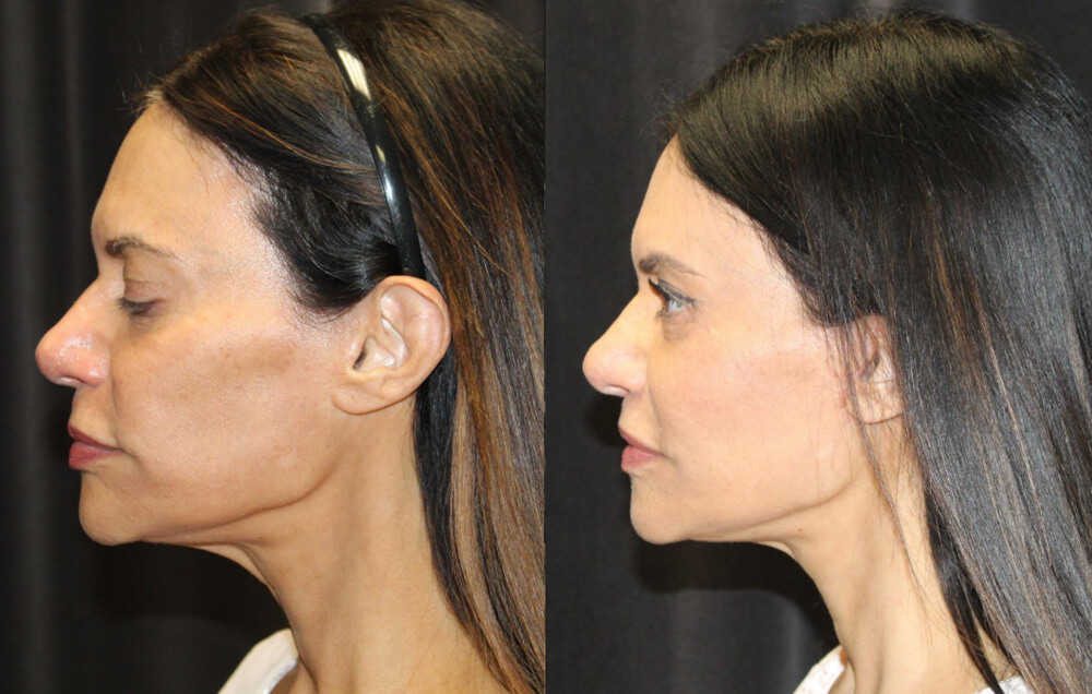 Cervicofacial rhytidectomy, High SMAS technique, 2. Superficial cheeklift, - (USIC), 3. Harvest of fat fascial grafts from lower abdomen, 4. LiveFill to malar eminences, 5. LiveFill to submalar region, 6. LiveFill to temporal hollowing, 7. Lateral brow lift, nerve sparing, 8. Reverse brow lift with galeal scoring bilateral , CO2 laser resurfacing of face