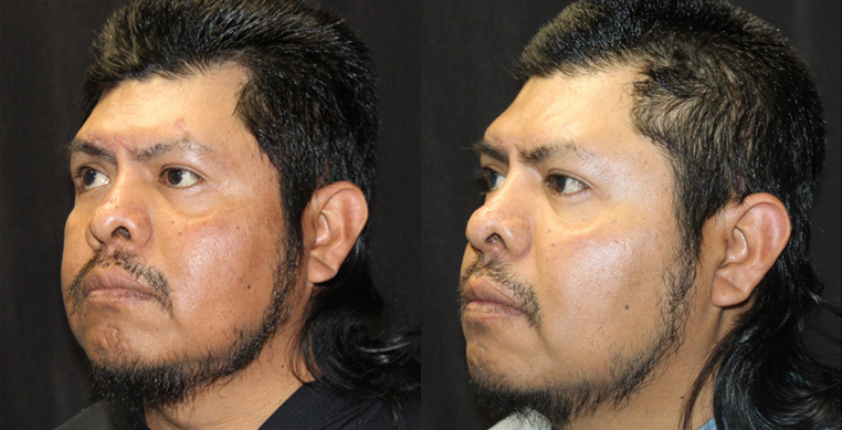 Facial scarring and nerve damage after an accident, treated with scar repairs, laser, nerve repairs.