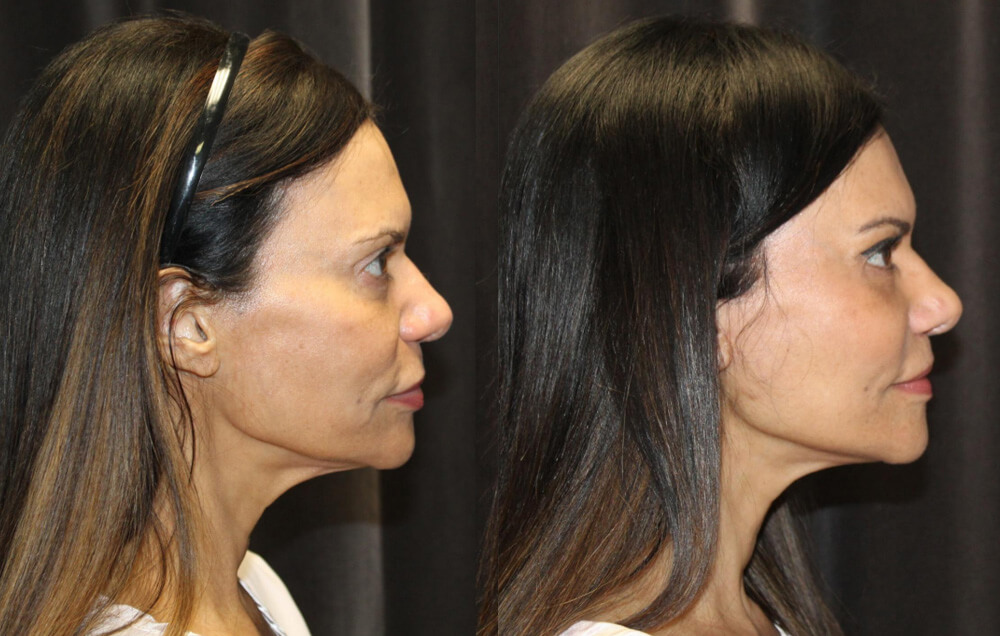 Cervicofacial rhytidectomy, High SMAS technique, 2. Superficial cheeklift, - (USIC), 3. Harvest of fat fascial grafts from lower abdomen, 4. LiveFill to malar eminences, 5. LiveFill to submalar region, 6. LiveFill to temporal hollowing, 7. Lateral brow lift, nerve sparing, 8. Reverse brow lift with galeal scoring bilateral , CO2 laser resurfacing of face