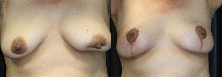 Breast Reconstruction of a patient who sustained a car accident, which caused internal scarring, capsular contracture, and internal scar tissue with deformation of her left breast.