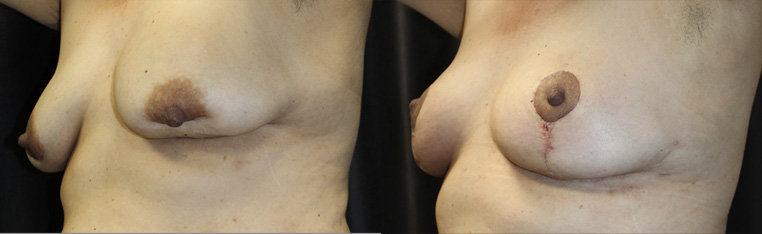 Breast Reconstruction of a patient who sustained a car accident, which caused internal scarring, capsular contracture, and internal scar tissue with deformation of her left breast.