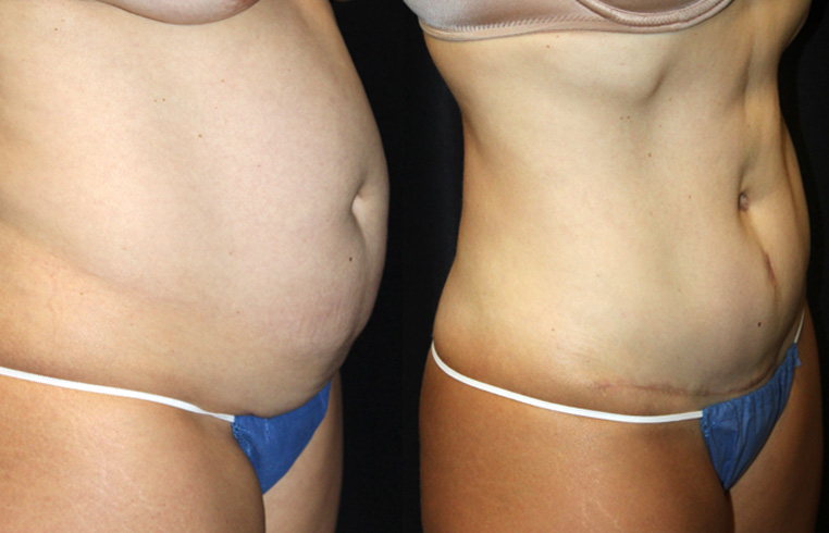 2.5 years after tummy tuck with vertical incision