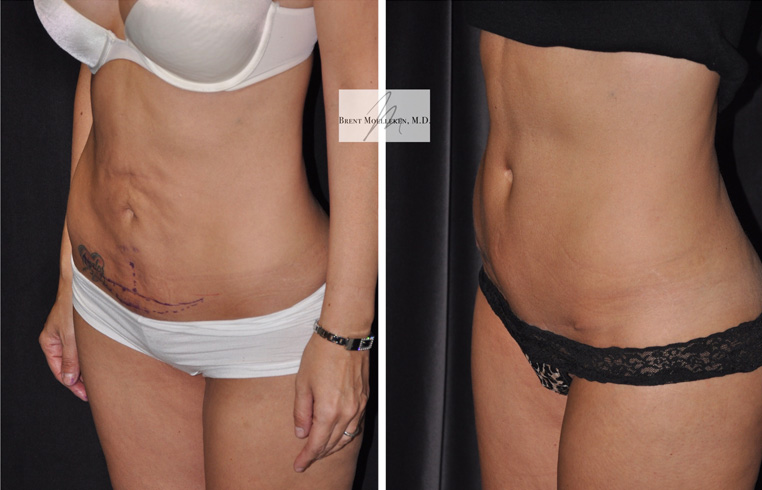 Modified Tummy Tuck with Vertical Incision