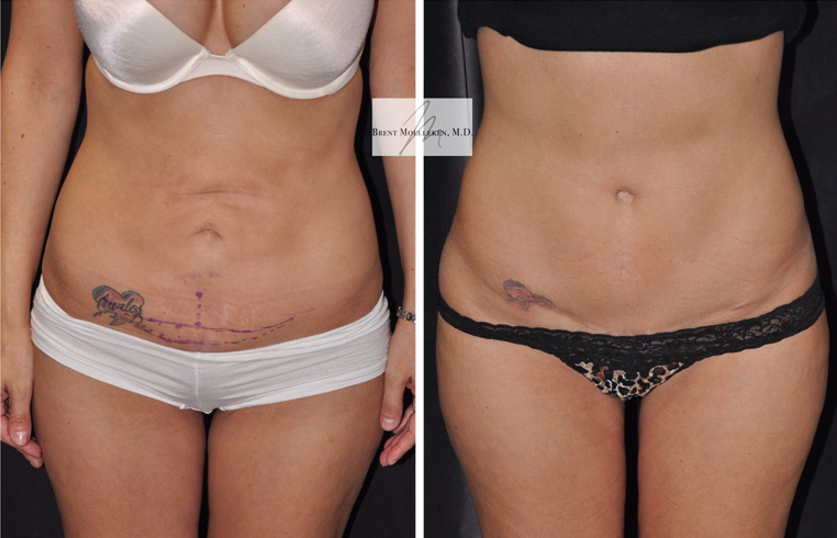 Modified Tummy Tuck with Vertical Incision